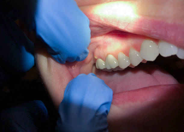 Best Emergency Treatment for Toothache in Columbus Junction, IA